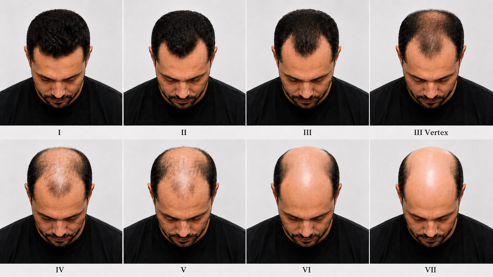 Escala de Norwood: como identificar seu estágio e por que ele não define seu tratamento